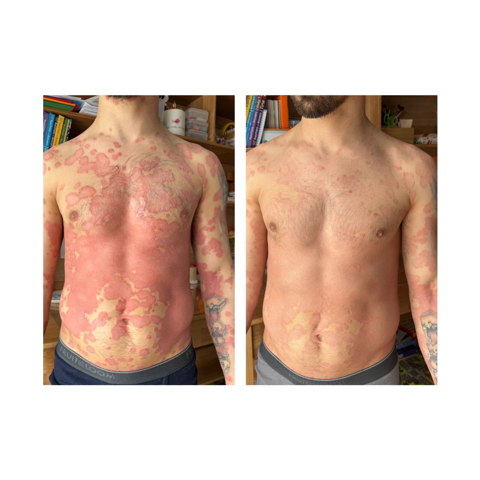 Psoriasis before and after