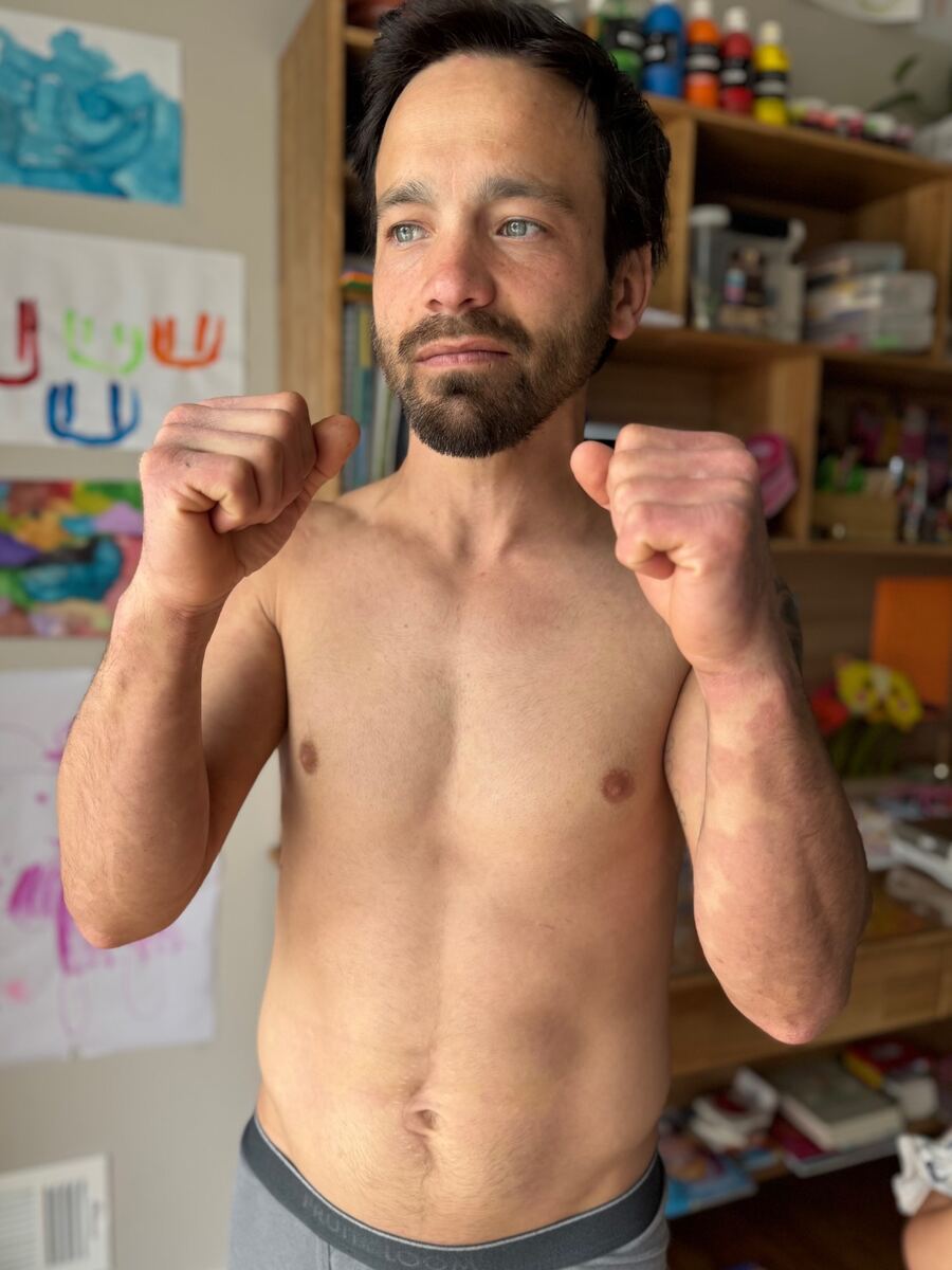 Fabio psoriasis transformation